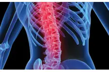 Fıtık Nedir? ve Nasıl Bir Hastalıktır