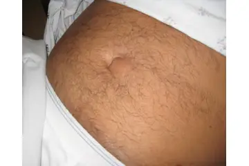 Göbek Fıtığının Zararları Nelerdir?