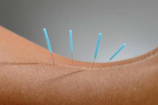 Akupunktur ile Bel Fıtığı Tedavisi