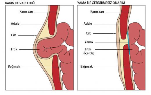 Bel Fıtığı Çeşitleri Nelerdir?