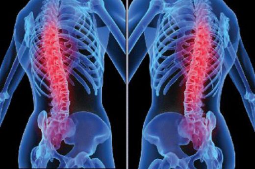 Bel Fıtığı Patlaması Ameliyatı Riskleri ve Sonrası