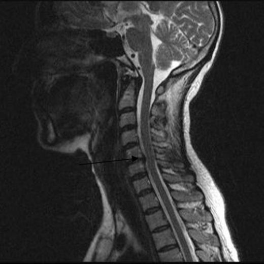 Boyun Fıtık Ameliyatı Riskleri ve Sonrası