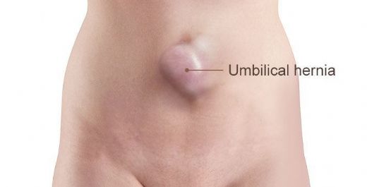 Göbek Deliği Fıtığı Belirtileri ve Tedavisi
