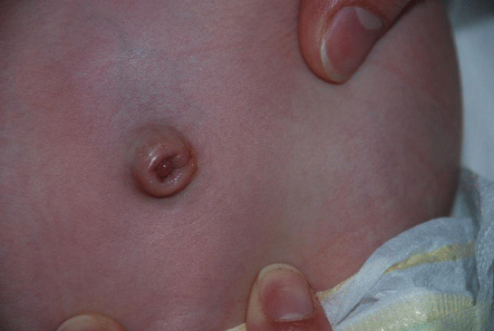 Bebeklerde Göbek Fıtığı Belirtileri ve Tedavisi