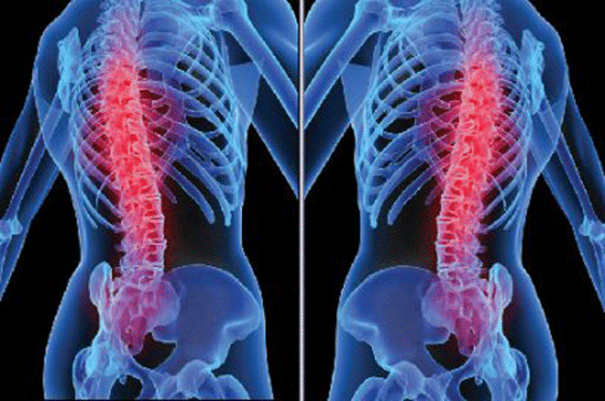 Bel Fıtığı Patlaması Belirtileri ve Tedavisi