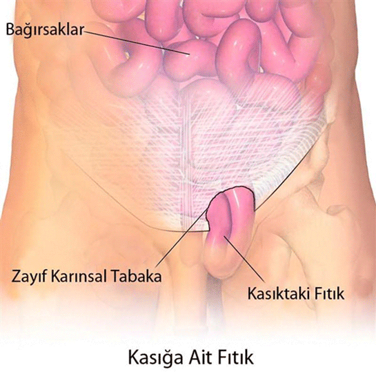 Fıtık Nerede Olur?